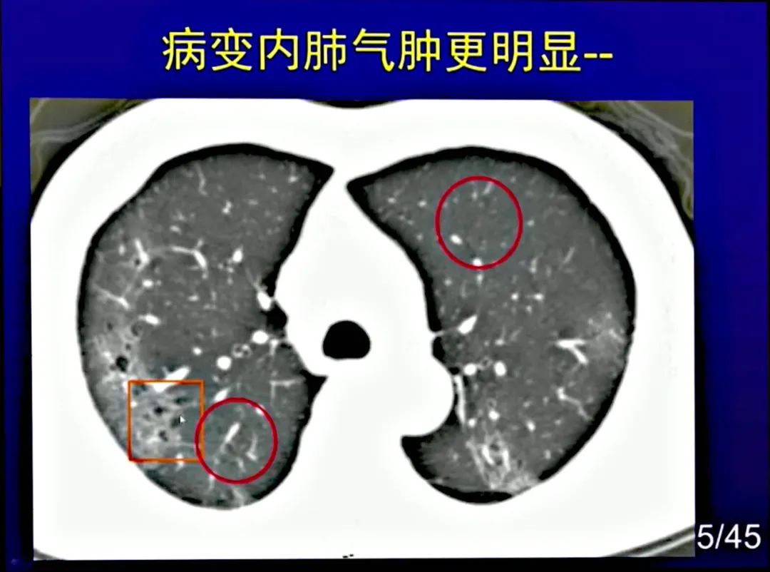 【PPT】新型冠状病毒感染CT早期诊断和鉴别诊断