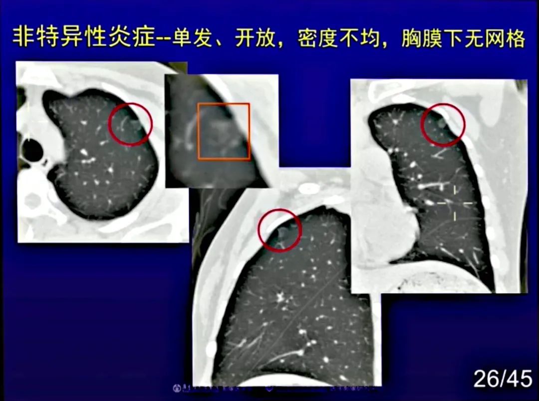 【PPT】新型冠状病毒感染CT早期诊断和鉴别诊断