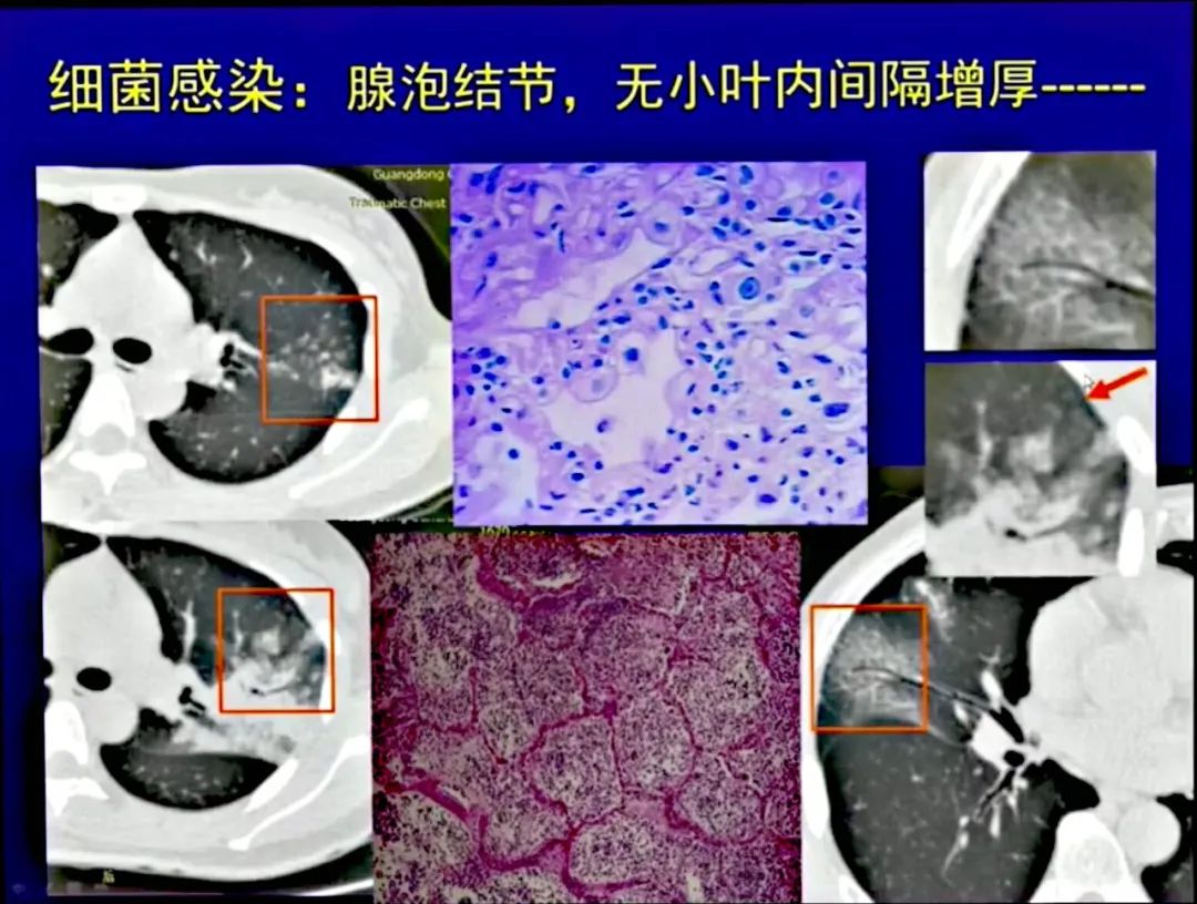 【PPT】新型冠状病毒感染CT早期诊断和鉴别诊断