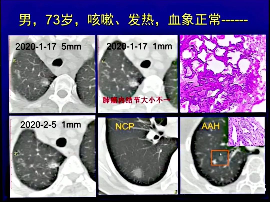 【PPT】新型冠状病毒感染CT早期诊断和鉴别诊断