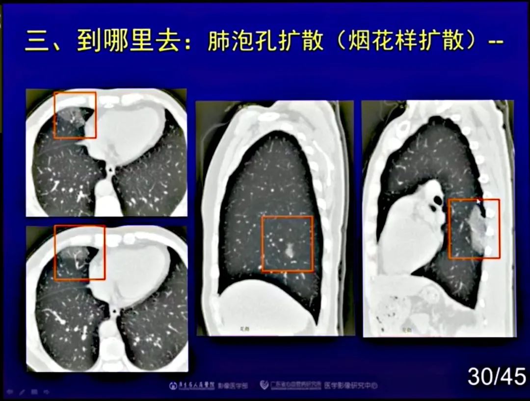 【PPT】新型冠状病毒感染CT早期诊断和鉴别诊断