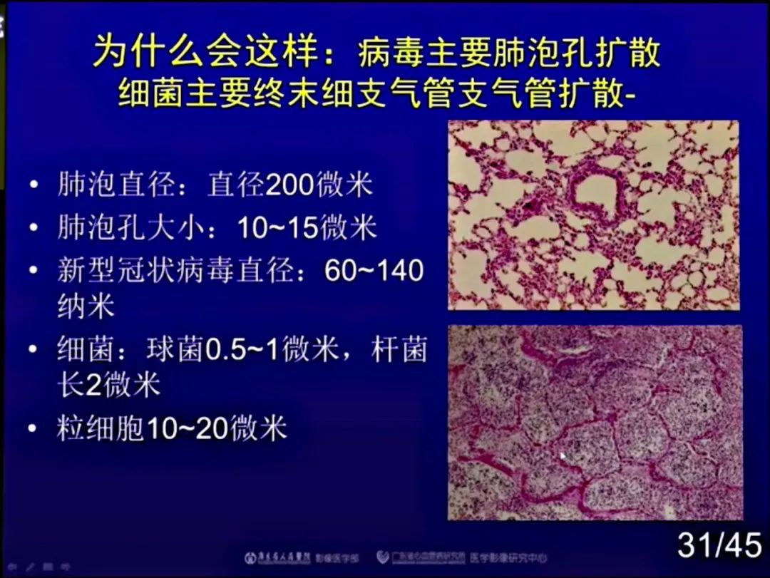 【PPT】新型冠状病毒感染CT早期诊断和鉴别诊断