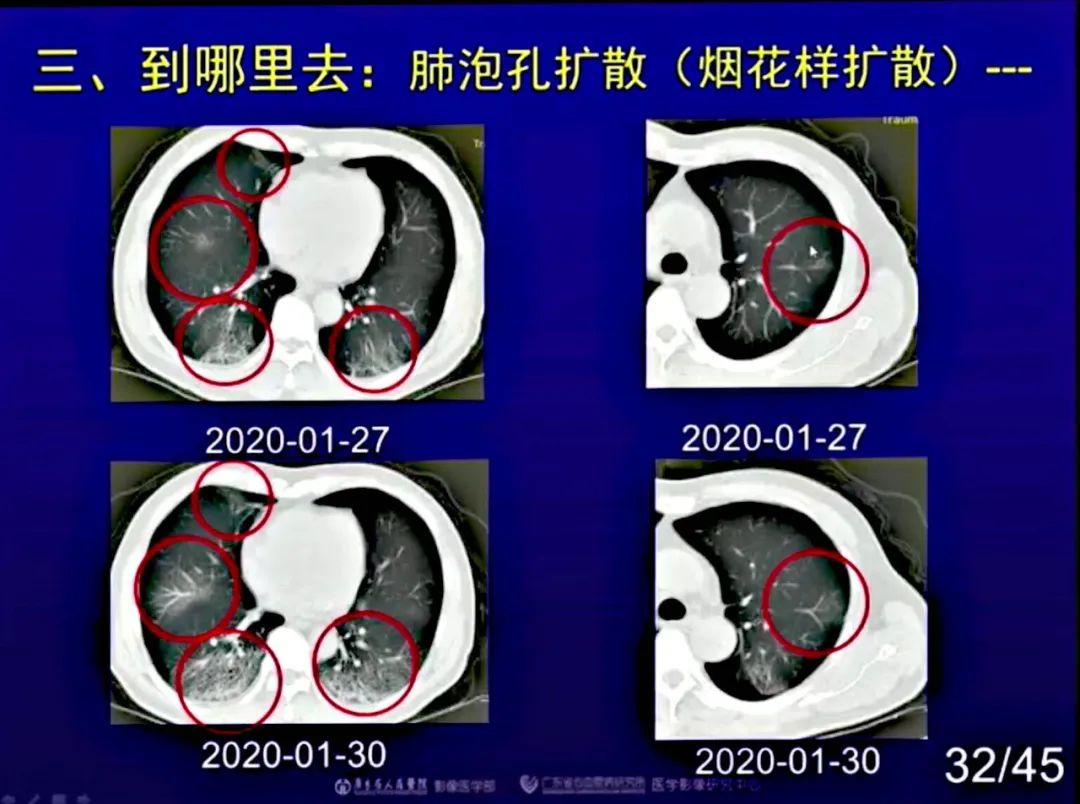 【PPT】新型冠状病毒感染CT早期诊断和鉴别诊断
