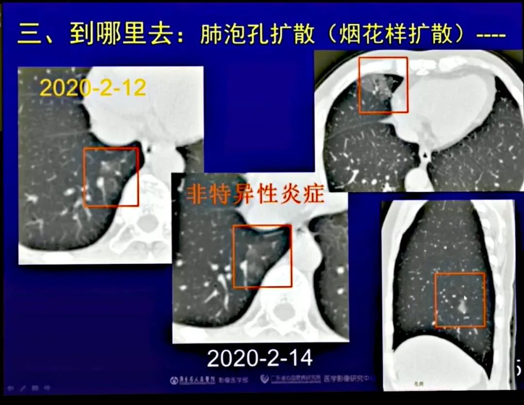 【PPT】新型冠状病毒感染CT早期诊断和鉴别诊断