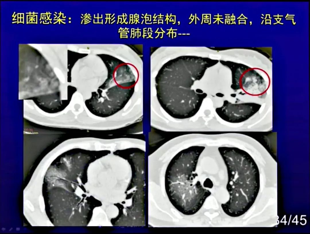 【PPT】新型冠状病毒感染CT早期诊断和鉴别诊断