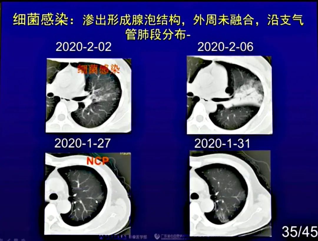 【PPT】新型冠状病毒感染CT早期诊断和鉴别诊断
