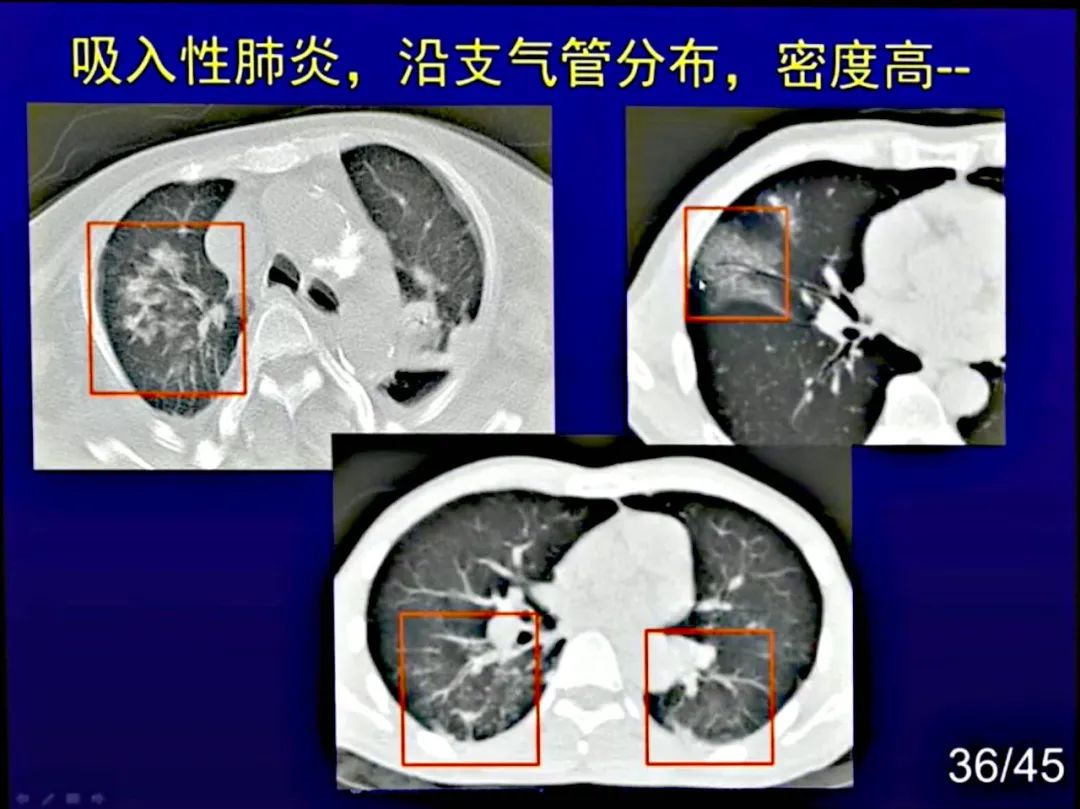 【PPT】新型冠状病毒感染CT早期诊断和鉴别诊断