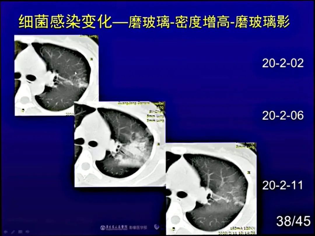 【PPT】新型冠状病毒感染CT早期诊断和鉴别诊断