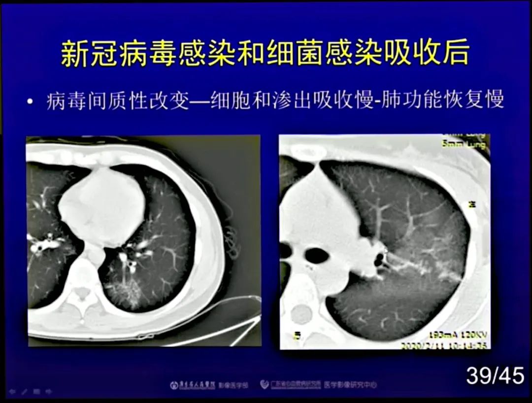 【PPT】新型冠状病毒感染CT早期诊断和鉴别诊断