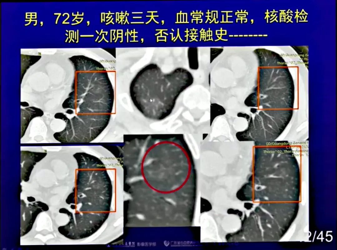 【PPT】新型冠状病毒感染CT早期诊断和鉴别诊断