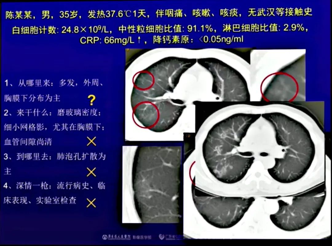 【PPT】新型冠状病毒感染CT早期诊断和鉴别诊断