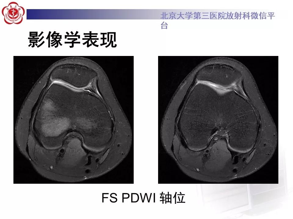 【PPT】髌股关节内侧滑膜皱襞综合征
