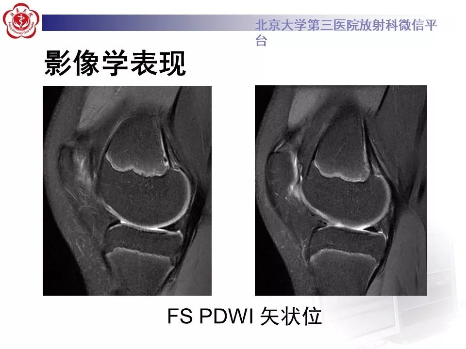 【PPT】髌股关节内侧滑膜皱襞综合征