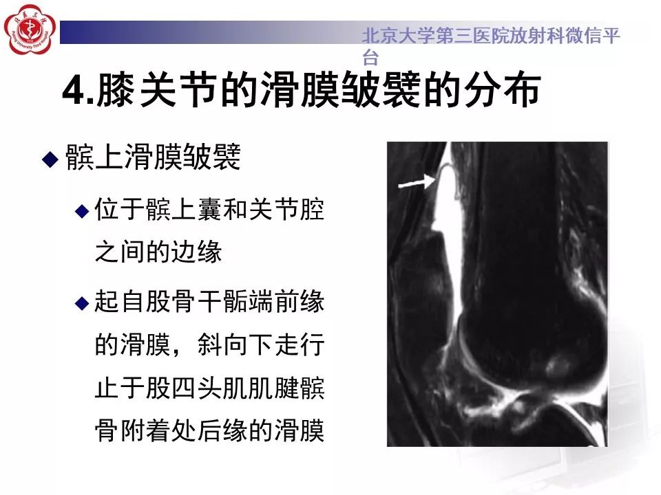 【PPT】髌股关节内侧滑膜皱襞综合征