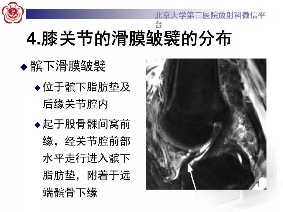 【PPT】髌股关节内侧滑膜皱襞综合征