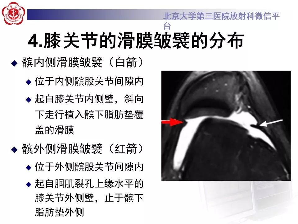 【PPT】髌股关节内侧滑膜皱襞综合征
