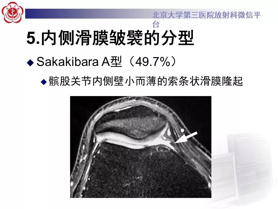 【PPT】髌股关节内侧滑膜皱襞综合征