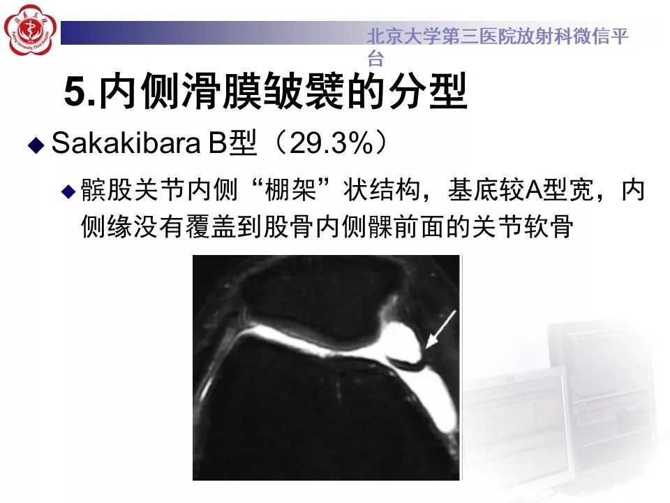 【PPT】髌股关节内侧滑膜皱襞综合征