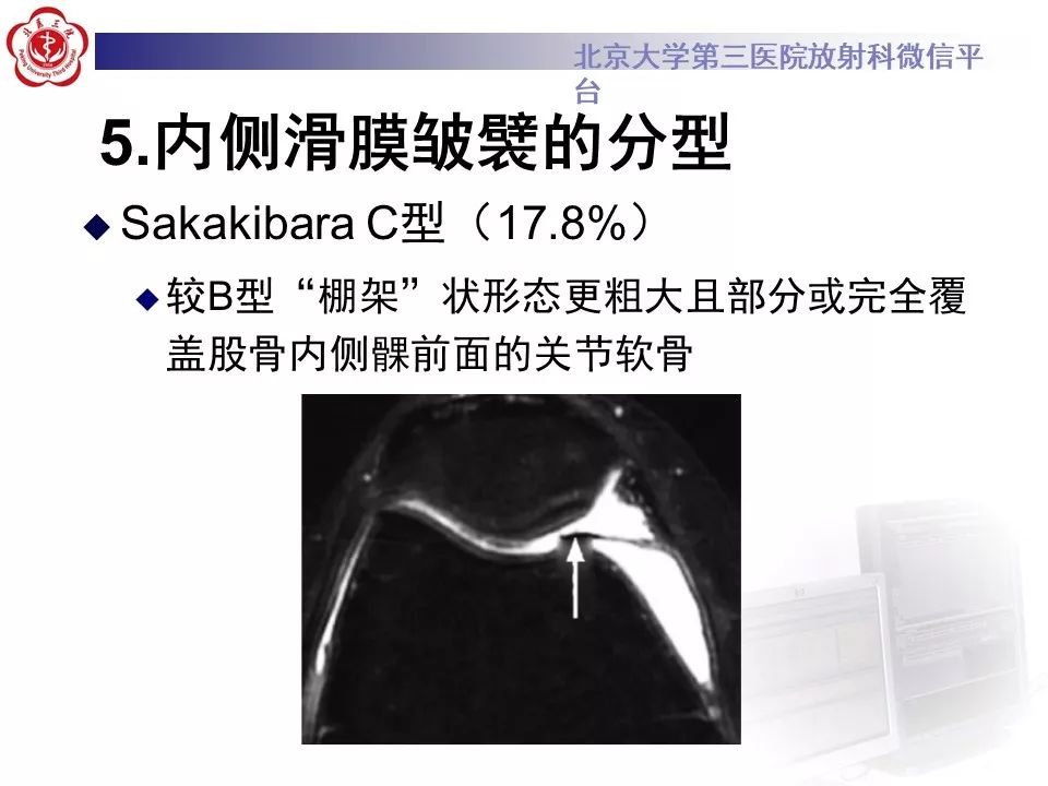 【PPT】髌股关节内侧滑膜皱襞综合征