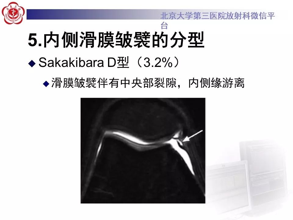 【PPT】髌股关节内侧滑膜皱襞综合征