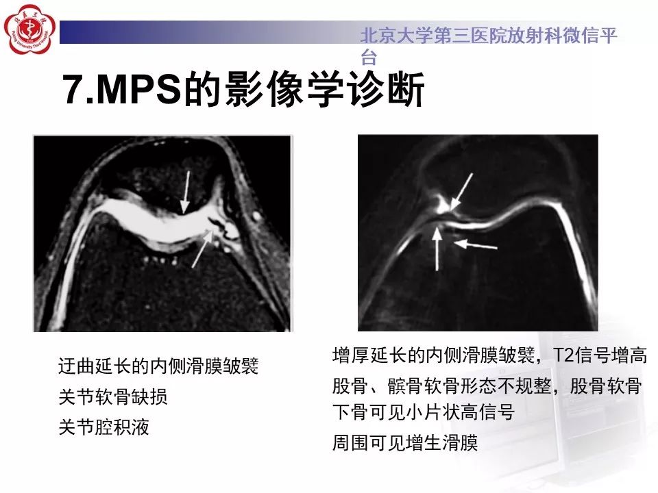 【PPT】髌股关节内侧滑膜皱襞综合征