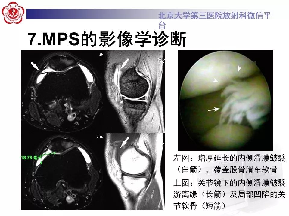 【PPT】髌股关节内侧滑膜皱襞综合征
