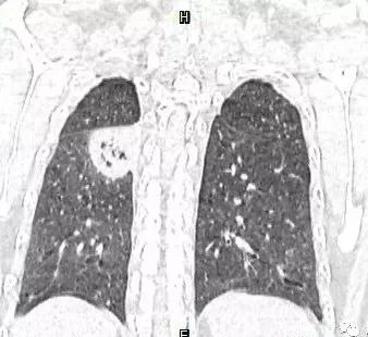 【病例】肺结核性空洞1例CT影像讨论分析 【病例】肺结核性空洞1例CT影像讨论分析