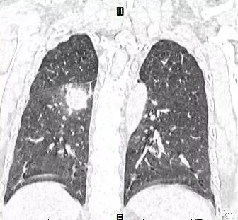 【病例】肺结核性空洞1例CT影像讨论分析 【病例】肺结核性空洞1例CT影像讨论分析