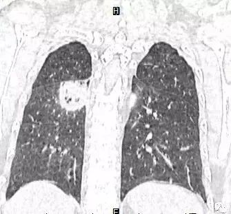【病例】肺结核性空洞1例CT影像讨论分析 【病例】肺结核性空洞1例CT影像讨论分析