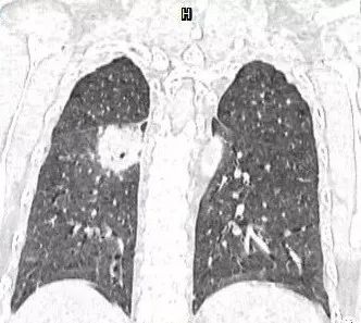 【病例】肺结核性空洞1例CT影像讨论分析 【病例】肺结核性空洞1例CT影像讨论分析