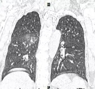 【病例】肺结核性空洞1例CT影像讨论分析 【病例】肺结核性空洞1例CT影像讨论分析