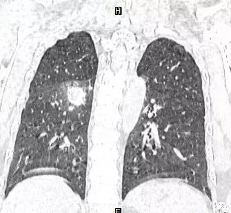 【病例】肺结核性空洞1例CT影像讨论分析 【病例】肺结核性空洞1例CT影像讨论分析