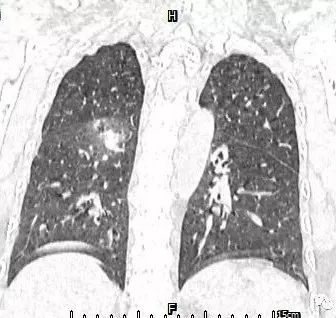 【病例】肺结核性空洞1例CT影像讨论分析 【病例】肺结核性空洞1例CT影像讨论分析