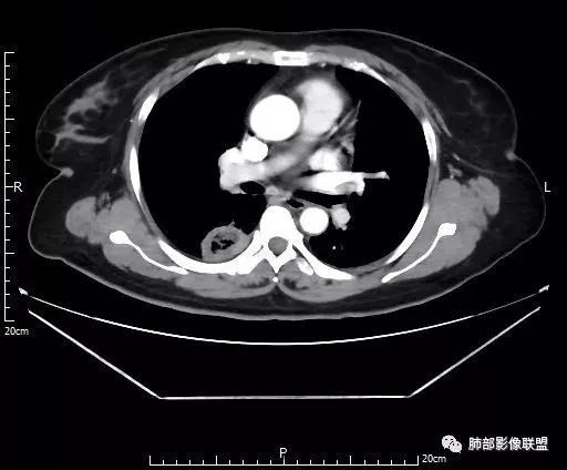【病例】肺结核性空洞1例CT影像讨论分析 【病例】肺结核性空洞1例CT影像讨论分析