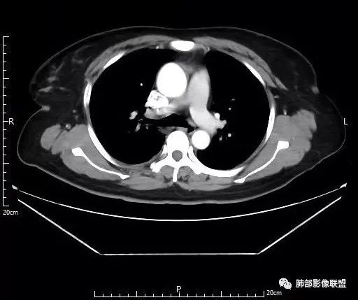 【病例】肺结核性空洞1例CT影像讨论分析 【病例】肺结核性空洞1例CT影像讨论分析