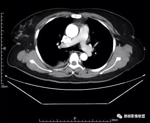 【病例】肺结核性空洞1例CT影像讨论分析 【病例】肺结核性空洞1例CT影像讨论分析