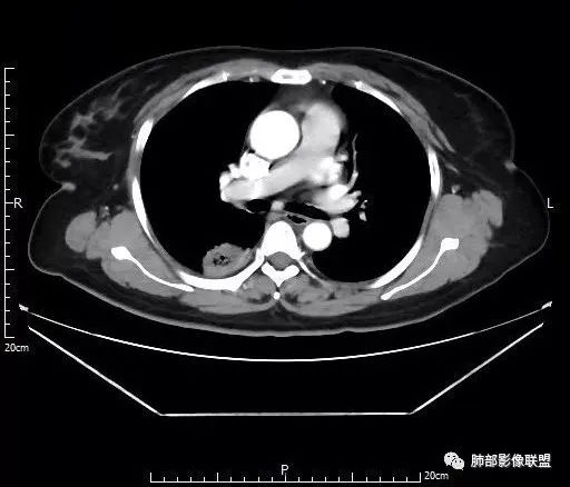 【病例】肺结核性空洞1例CT影像讨论分析 【病例】肺结核性空洞1例CT影像讨论分析