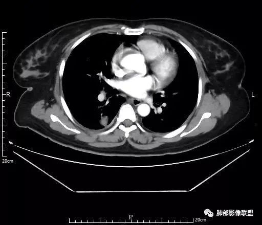【病例】肺结核性空洞1例CT影像讨论分析 【病例】肺结核性空洞1例CT影像讨论分析