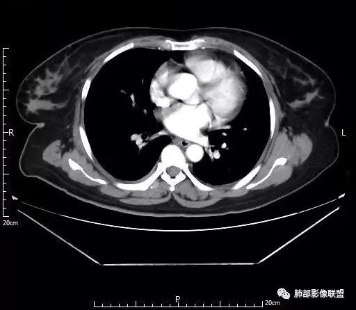 【病例】肺结核性空洞1例CT影像讨论分析 【病例】肺结核性空洞1例CT影像讨论分析