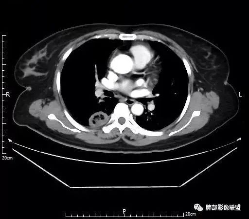 【病例】肺结核性空洞1例CT影像讨论分析 【病例】肺结核性空洞1例CT影像讨论分析