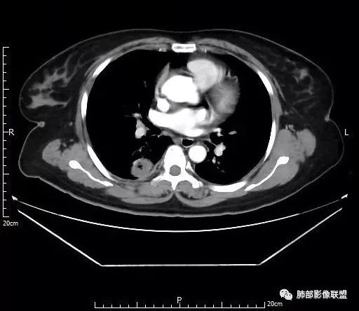 【病例】肺结核性空洞1例CT影像讨论分析 【病例】肺结核性空洞1例CT影像讨论分析