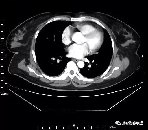 【病例】肺结核性空洞1例CT影像讨论分析 【病例】肺结核性空洞1例CT影像讨论分析