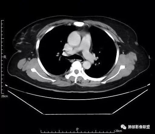 【病例】肺结核性空洞1例CT影像讨论分析 【病例】肺结核性空洞1例CT影像讨论分析