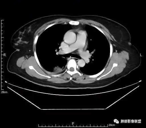 【病例】肺结核性空洞1例CT影像讨论分析 【病例】肺结核性空洞1例CT影像讨论分析