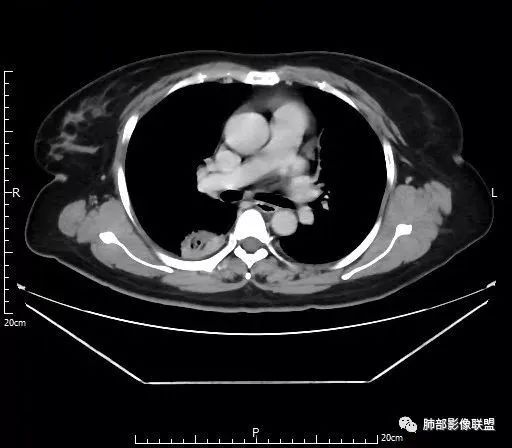 【病例】肺结核性空洞1例CT影像讨论分析 【病例】肺结核性空洞1例CT影像讨论分析