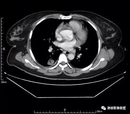 【病例】肺结核性空洞1例CT影像讨论分析 【病例】肺结核性空洞1例CT影像讨论分析