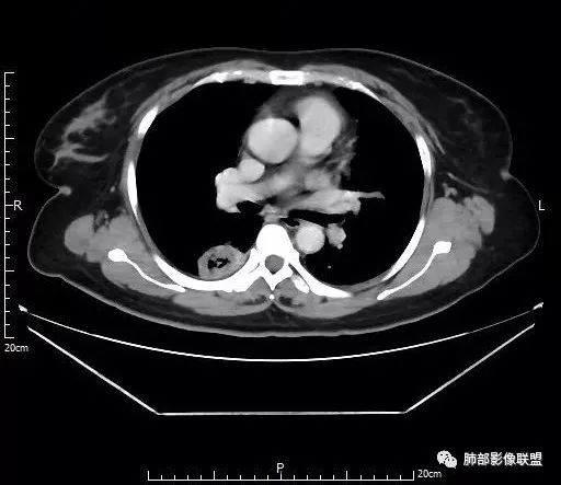 【病例】肺结核性空洞1例CT影像讨论分析 【病例】肺结核性空洞1例CT影像讨论分析