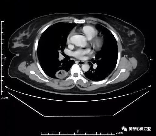 【病例】肺结核性空洞1例CT影像讨论分析 【病例】肺结核性空洞1例CT影像讨论分析