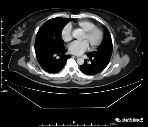 【病例】肺结核性空洞1例CT影像讨论分析 【病例】肺结核性空洞1例CT影像讨论分析