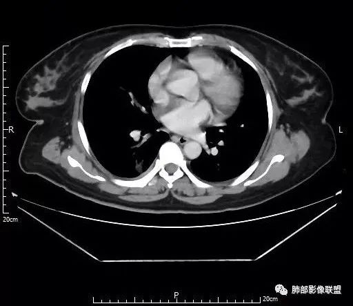 【病例】肺结核性空洞1例CT影像讨论分析 【病例】肺结核性空洞1例CT影像讨论分析